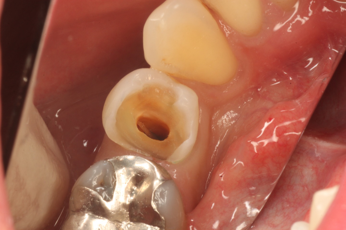 2.感染歯質を除去し、良好な根管治療が行える状態にする