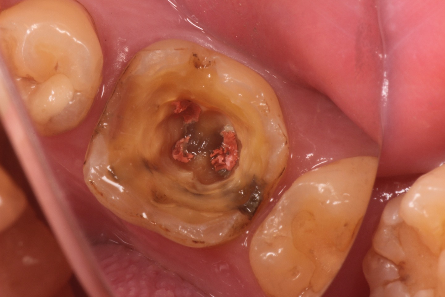 3.歯質の感染と以前の治療によって詰められた根管のお薬の腐敗も確認。歯質自体も部分的に軟かくなっている。