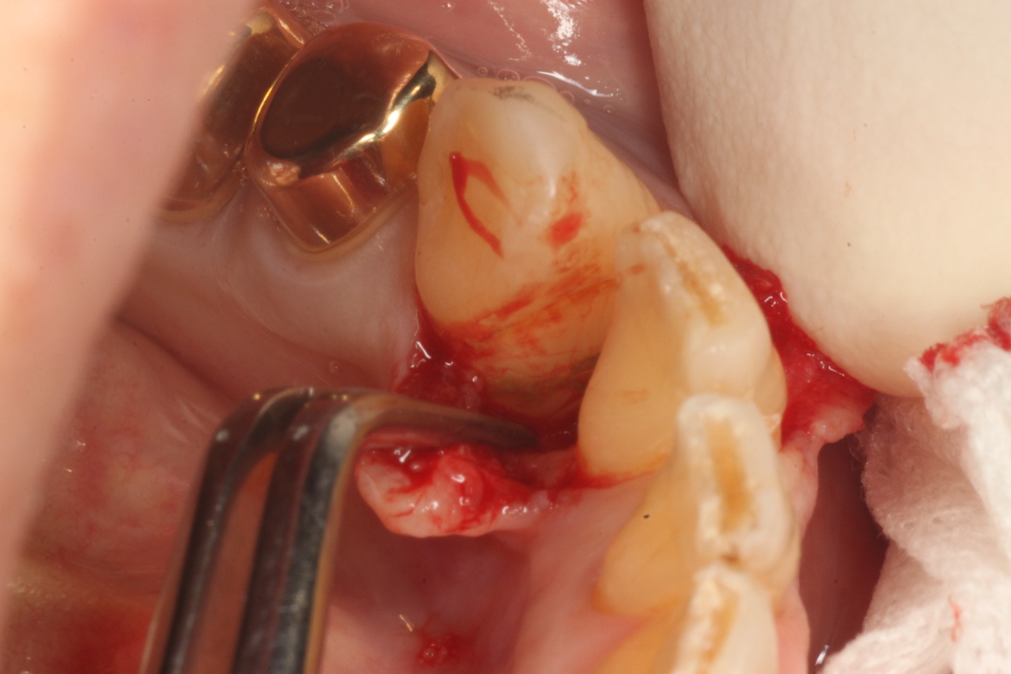 3.歯周病の進行程度によっては歯肉切開を行い、深い歯周ポケットの原因となる歯根表面の歯石、細菌バイオフィルムnの除去を行う。