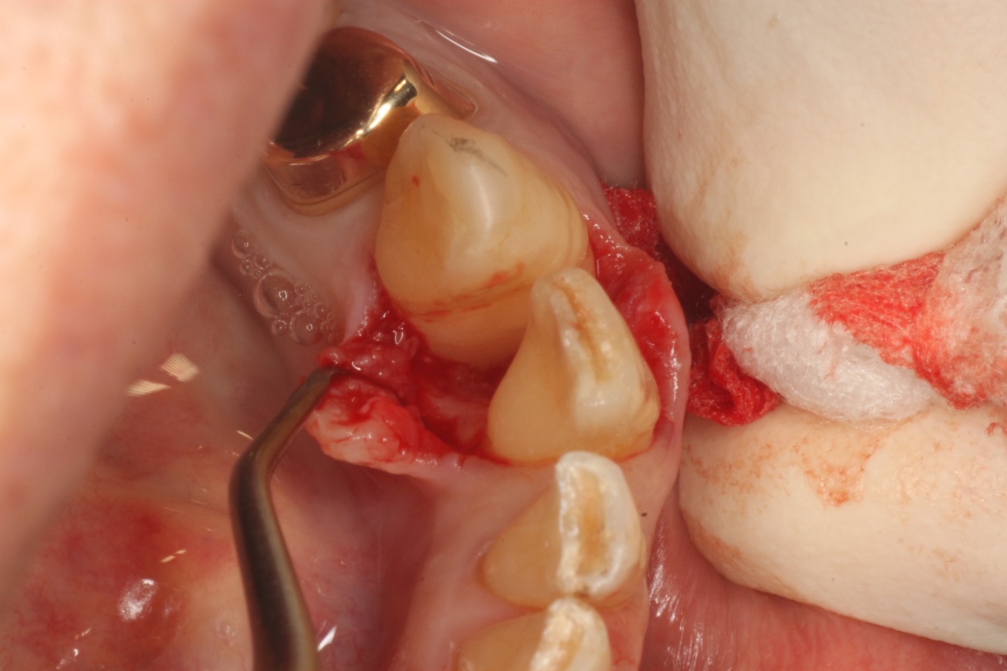 4.歯周ポケットの原因物質を除去することで、歯の周りを支えている骨（歯槽骨）の再生ができる環境をつくる。