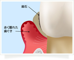 歯周病治療