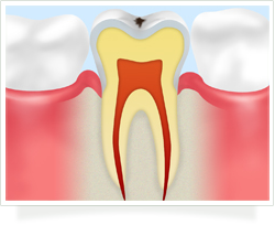 軽度のむし歯