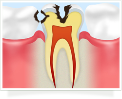中等度のむし歯