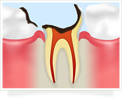 重度のむし歯