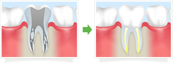 根管治療とは