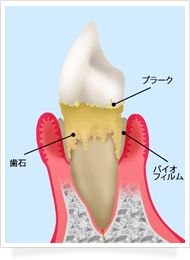 歯周病