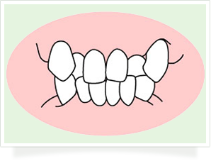 咬み合わせに関して