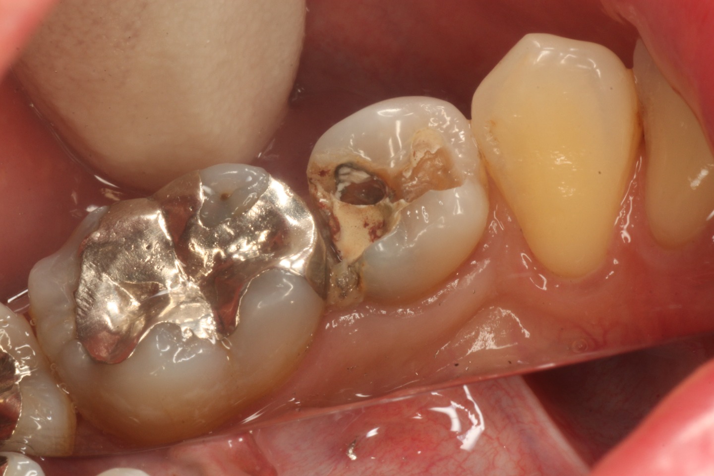 1.金属の詰め物が脱離して来院さ れたが、むし歯が大きく、歯髄組織（歯の神経と血管の組織）が壊死するまでに至ったケース