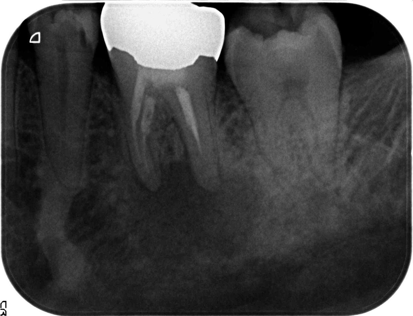 1.根の先端部分に炎症を示す黒い透過像を認める（慢性根尖性歯周組織炎の疑い）。根管内の感染が強く疑われる症例。
