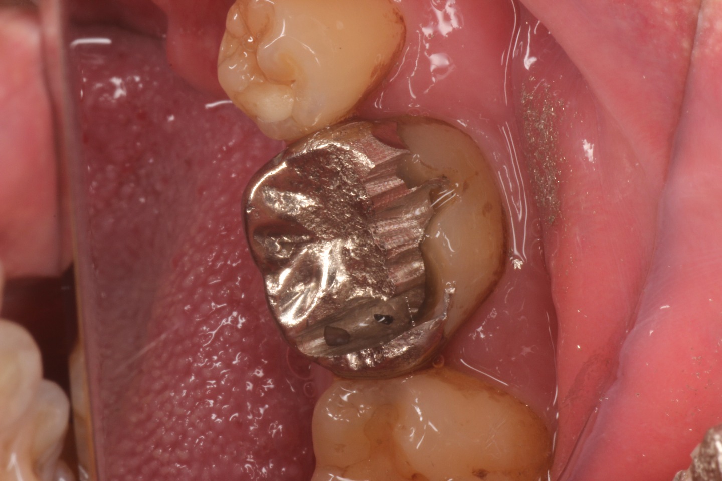 2.被せ物を除去することで、金属と歯質の隙間を確認。長期間に亘って唾液の進入があったことが疑われる。