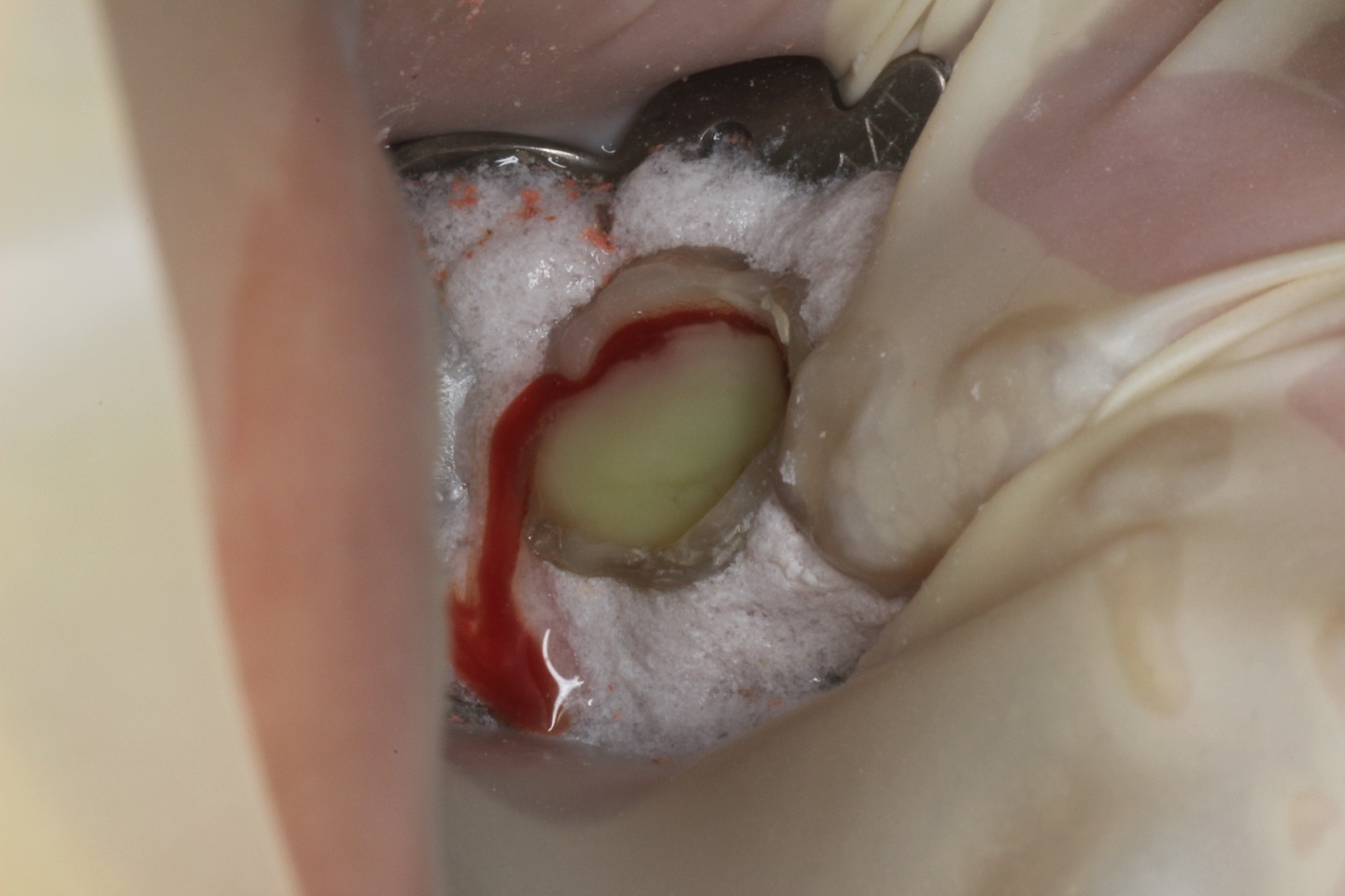 4.根管治療に際して無菌化を図るためのラバーダム防湿を行い治療を開始したところ、根の先端部分に溜まっていた膿が溢出してきた。このような膿が身体に存在して良いことは勿論ない。
