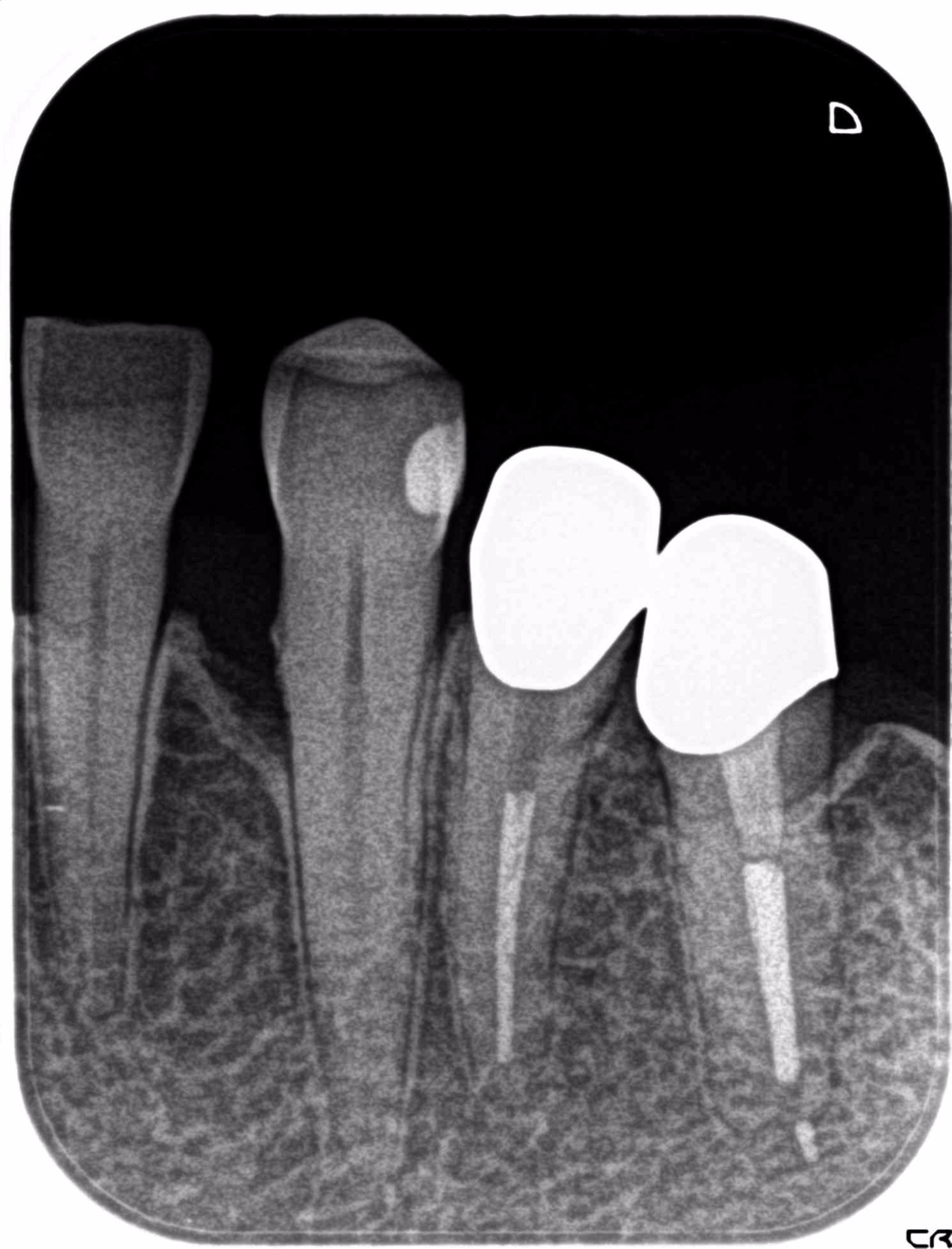 1.レントゲン診査にて歯周病による骨の吸収を認める