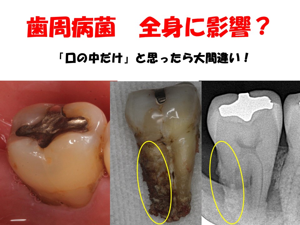 歯周病を放置した結果‥‥