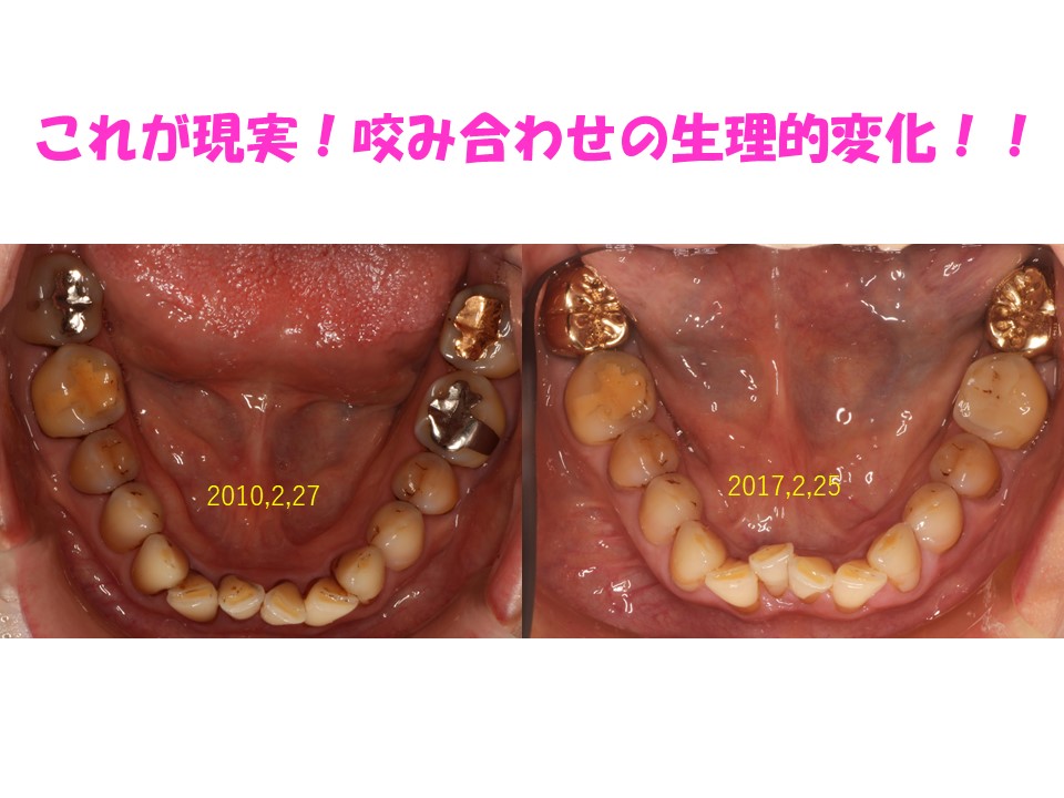 これが現実！咬み合わせの生理的変化！！