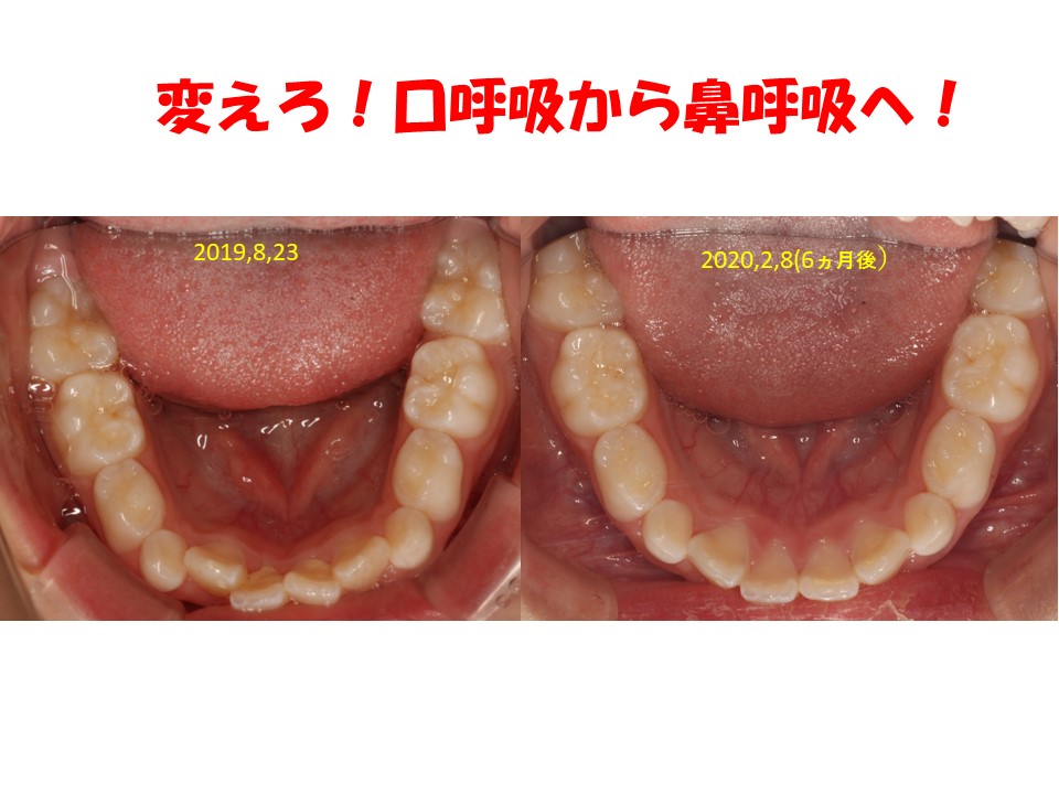 変えろ！口呼吸から鼻呼吸へ！