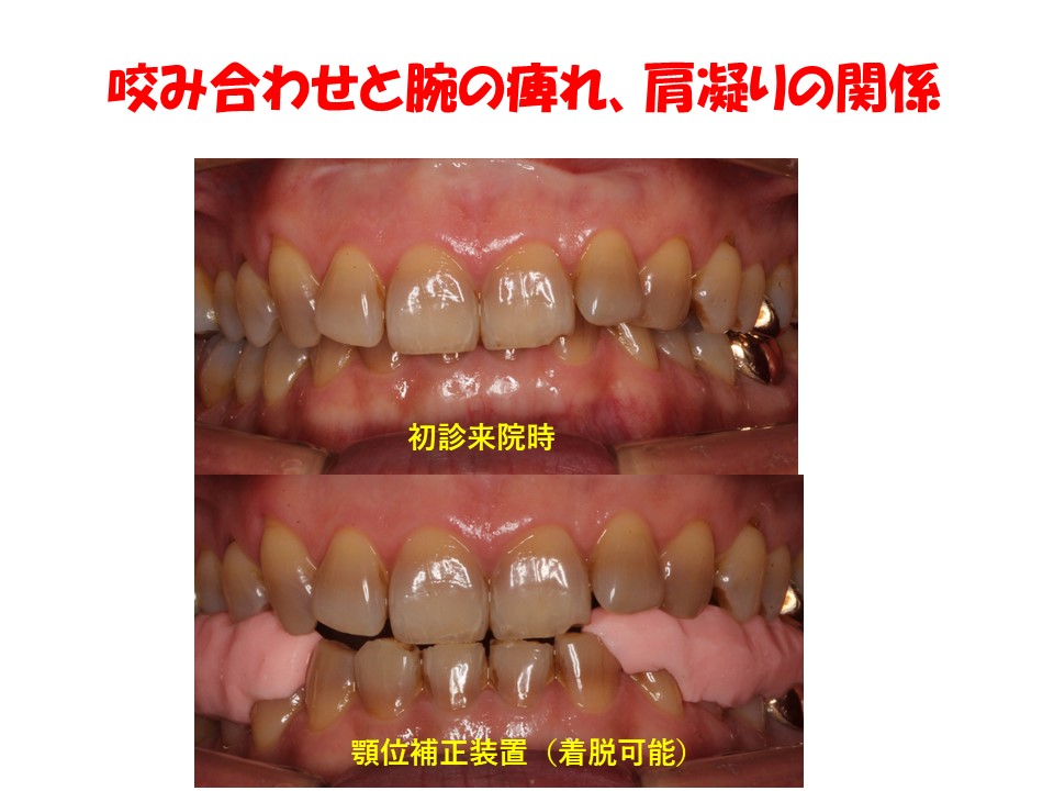 咬み合わせと腕の痺れ、肩凝りの関係