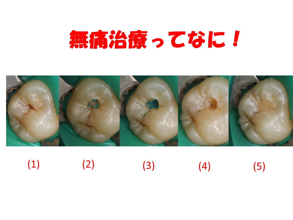 無痛治療ってなに！