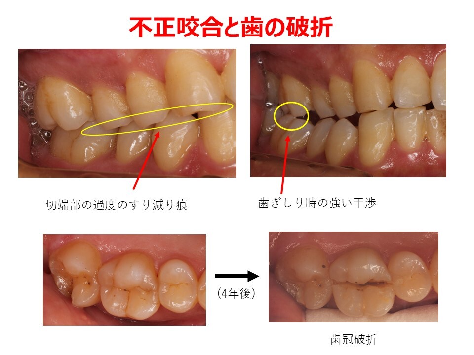 不正咬合と歯の破折