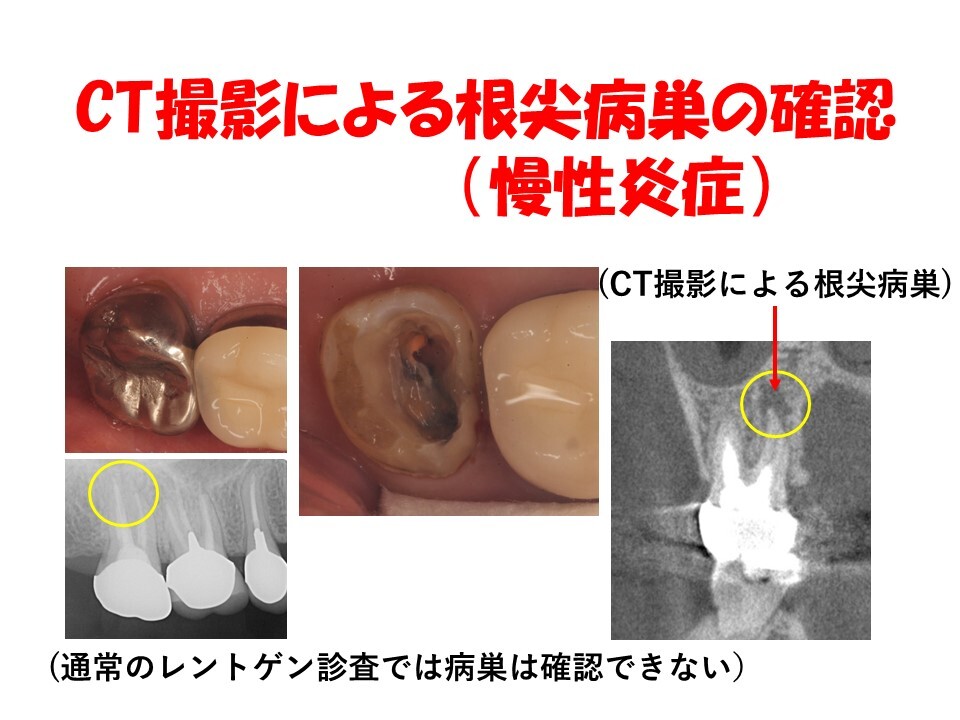 慢性炎症が引き起こす症状・疾患