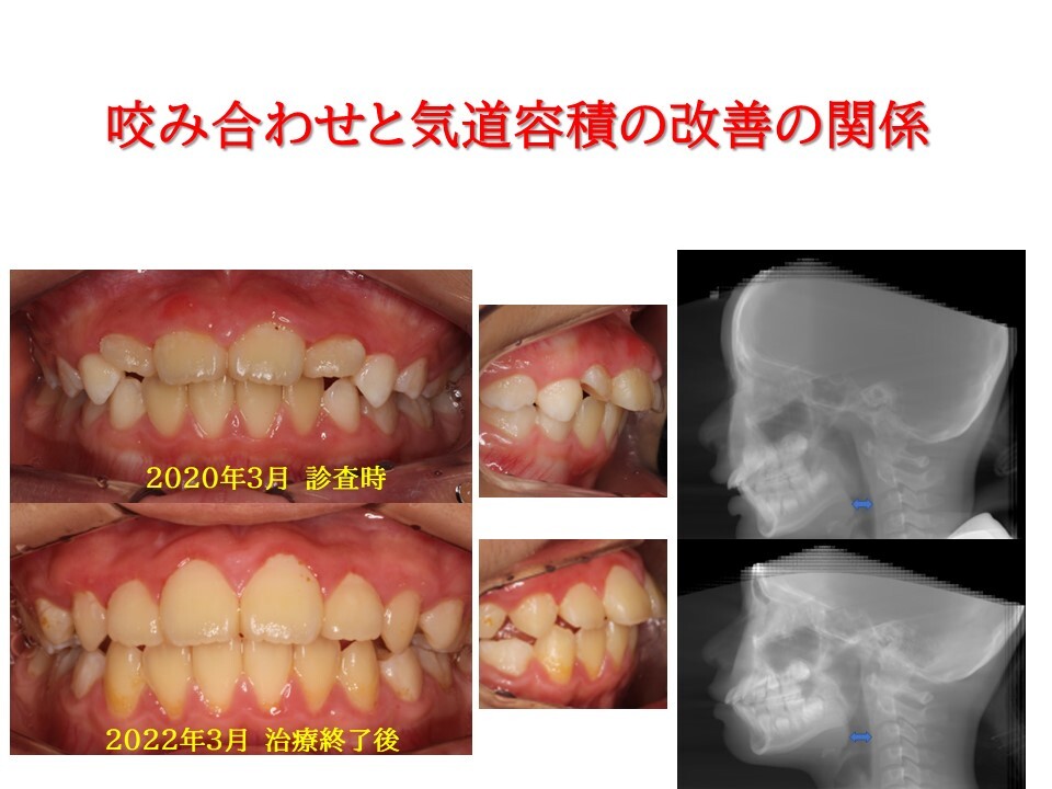 咬み合わせと気道容積の改善の関係