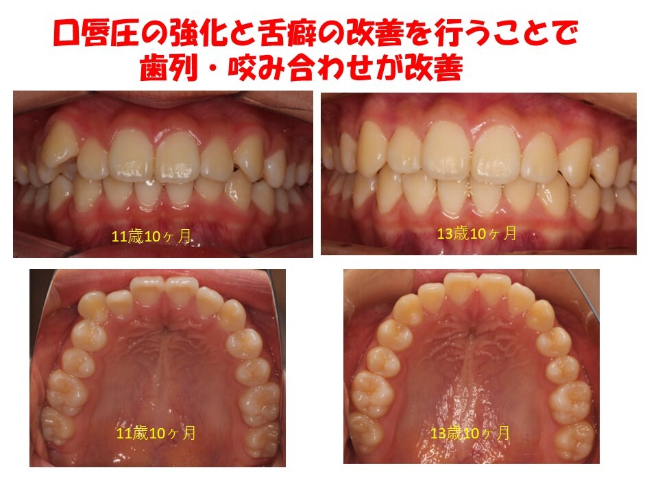 呼吸と口腔周囲筋のトレーニング