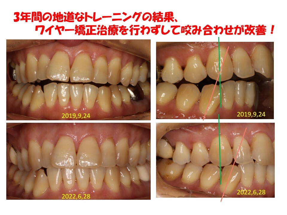 不正咬合に至った原因を除去すると・・・