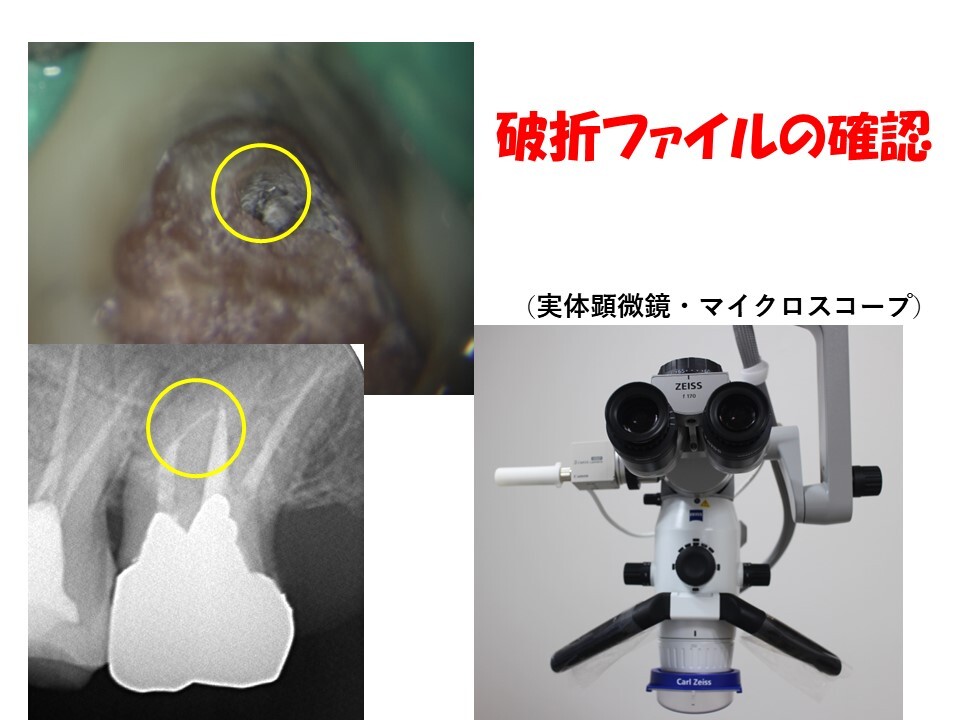 根管内に取り残された破折器具の除去