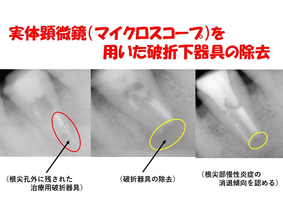 根管内に取り残された破折器具の除去