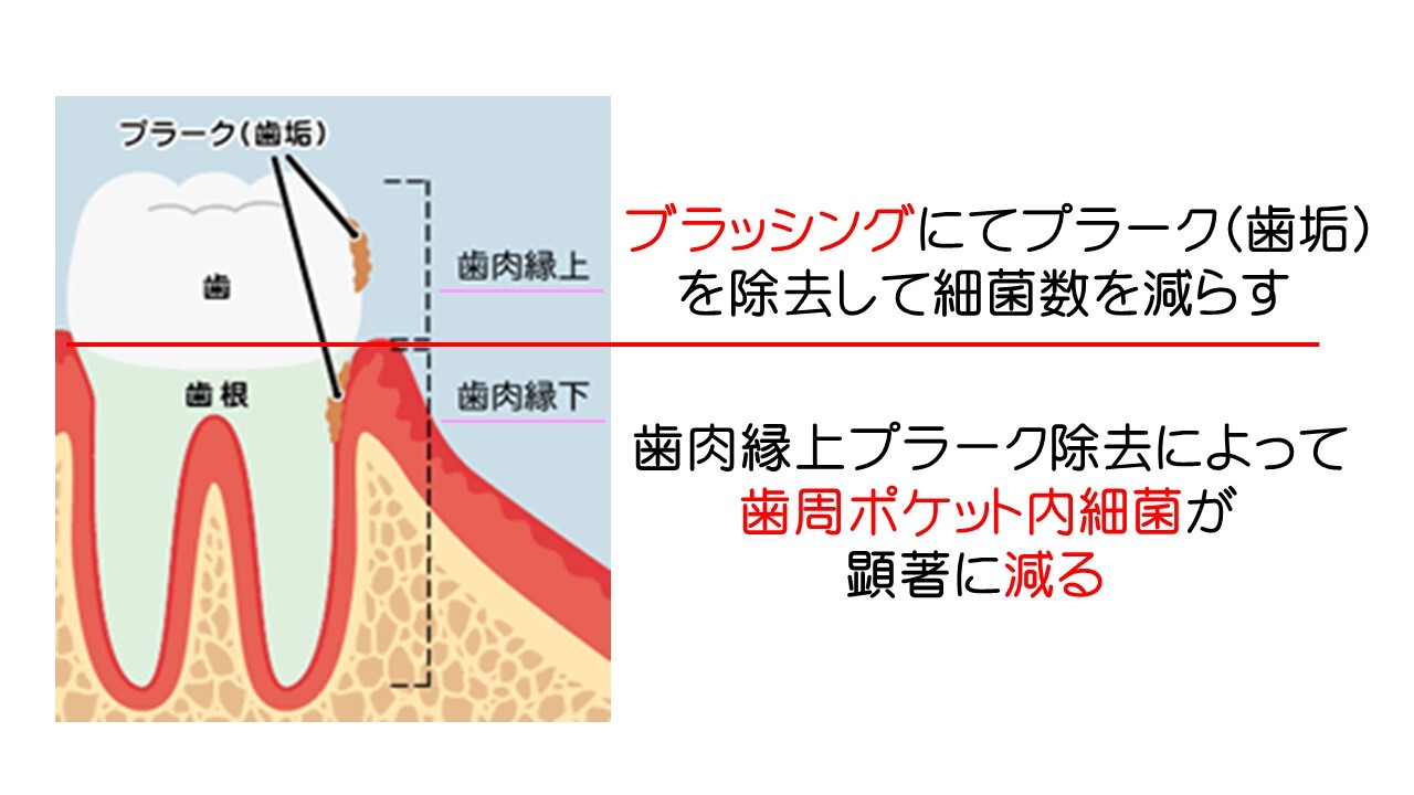 なぜ正しいブラッシングが必要なのでしょうか？