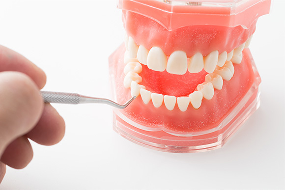 歯に使用する材質