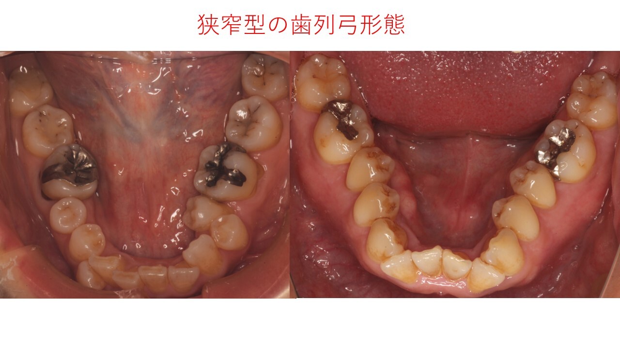 睡眠時無呼吸の病態