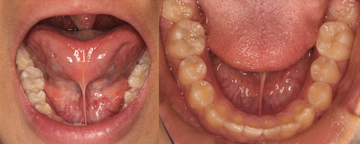 舌小帯短縮症・舌癒着症（Tongue-tie)/上唇小帯短縮症