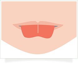 舌小帯短縮症・舌癒着症(Tongue-tie)/上唇小帯短縮症